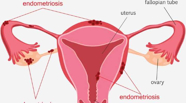 Everything to know about endometriosis during pregnancy