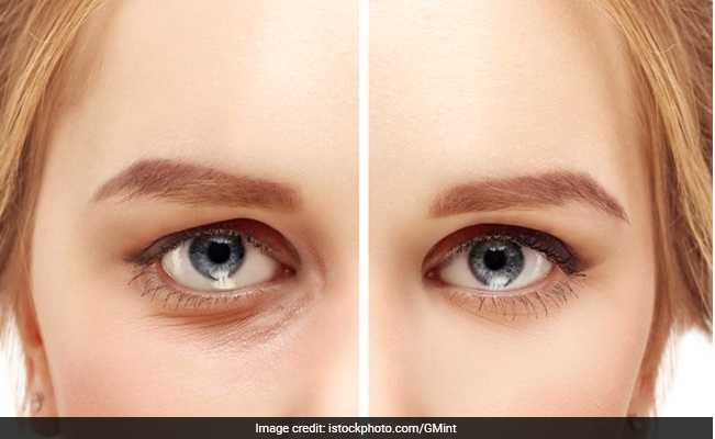 Dark Circles and Puffy Eyes? Know more from an expert