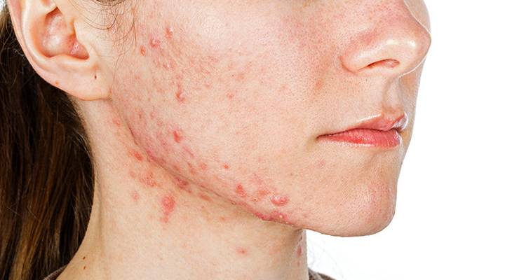 How to have acne free skin through Ayurveda
