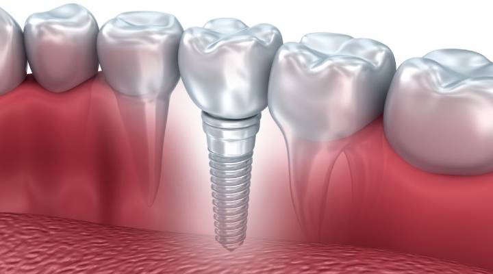 The Cost of Dental Implants: What You Need to Know