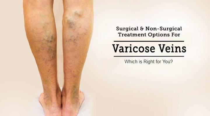 Varicose Vein Surgery vs. Non-Surgical Treatments: Which is Right for You?