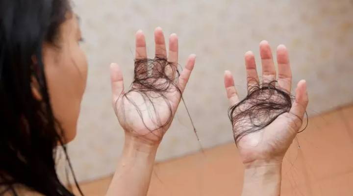 The Role of Homeopathy in Controlling Hair Fall in monsoon: A Natural Approach towards a Healthy Hair